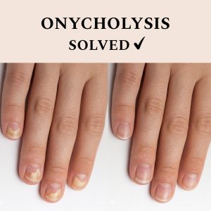 Nail Recover FEHU - līdzeklis nagu atjaunošanai un sēnīšu izplatīšanās novēršanai, 12 ml.